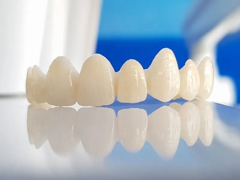 Răng toàn sứ được chế tác hoàn toàn từ sứ nguyên khối.