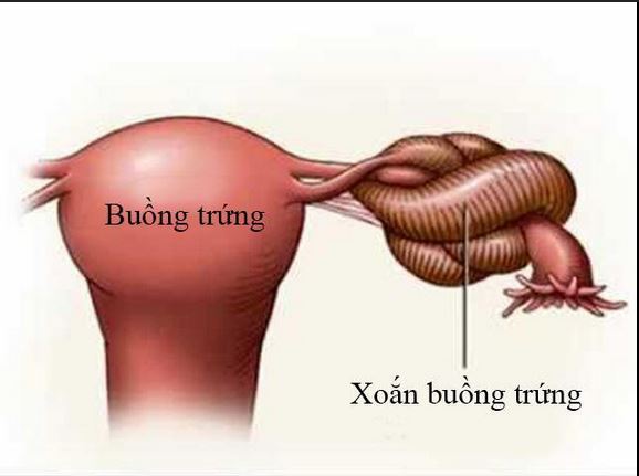 Cảnh Báo Về Xoắn U Nang Buồng Trứng: Hiện Tượng Nguy Hiểm Nên Nhận Biết Sớm
