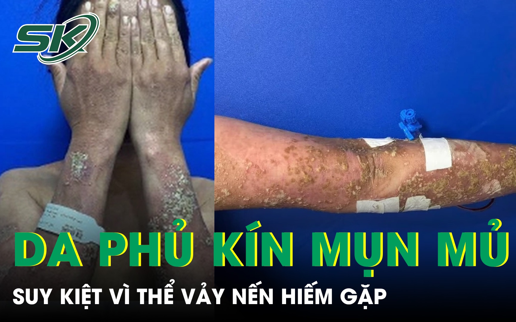 Nguy Cơ Từ Việc Tự Ý Sử Dụng Thuốc Điều Trị Vảy Nến: Những Điều Cần Biết
