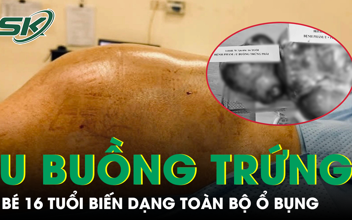 Cảnh giác với các dấu hiệu khối u buồng trứng ở trẻ em