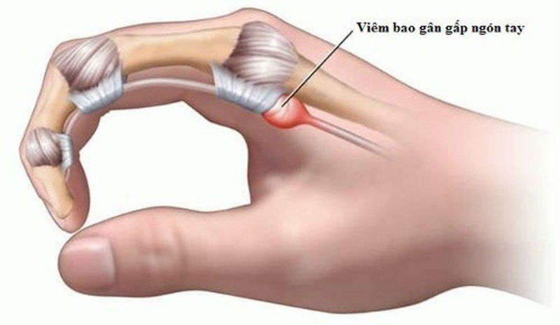 Cảnh Giác Với Triệu Chứng Đau Ngón Tay: Viêm Gân Gấp Ngón Tay Là Gì?