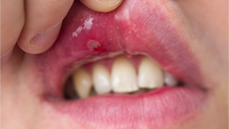 Chăm sóc răng miệng cho người bệnh Lupus ban đỏ