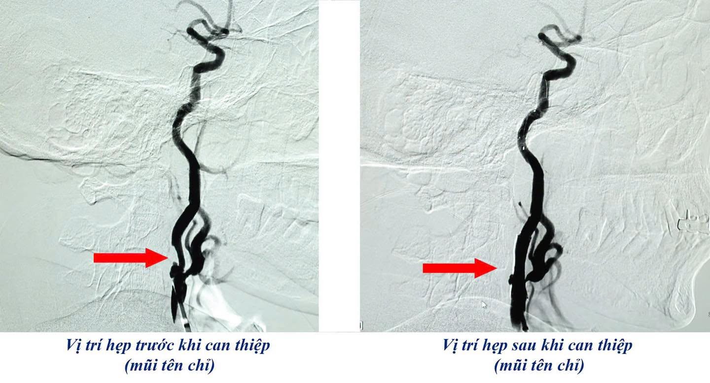 Giải Pháp Can Thiệp Nội Mạch Cho Bệnh Nhân Lớn Tuổi: Câu Chuyện Cứu Sống