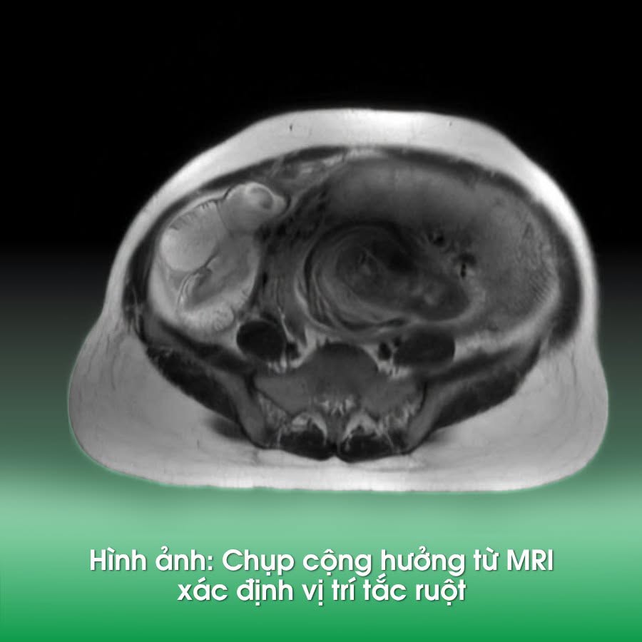 Thai phụ 35 tuần tắc ruột, cuộc phẫu thuật căng thẳng giữ an toàn cho bé- Ảnh 1.