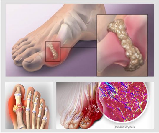 Tác Động Của Acid Uric Tăng Cao Đến Sức Khỏe Sinh Lý Nam Giới