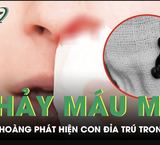 Nguy Cơ Mất Thị Lực Từ Một Tai Nạn Không Ngờ Tới