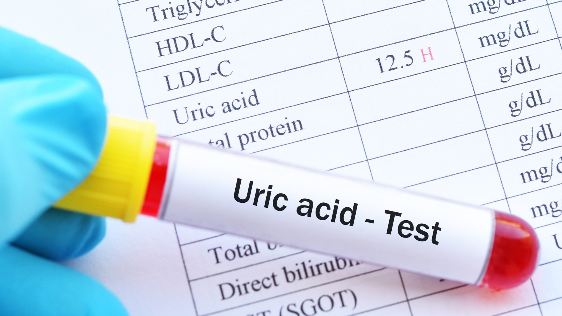 Tác Động Của Acid Uric Tăng Cao Đến Sức Khỏe Sinh Lý Nam Giới - Ảnh 1.