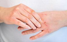 Chọn Giải Pháp Điều Trị Bướu Nhân Tuyến Giáp: Phẫu Thuật Hay Đốt Sóng Cao Tần?