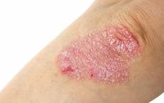 Tìm Hiểu Vai Trò của Xét Nghiệm ctDNA Trong Điều Trị Ung Thư Đại Tràng