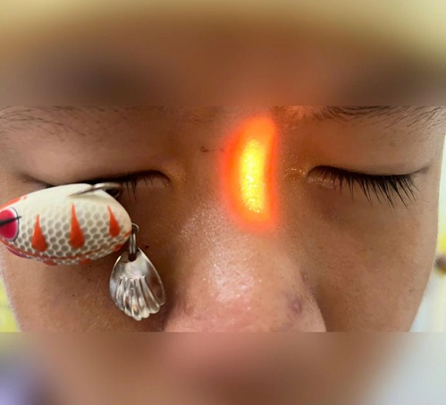 Chấn thương mắt do móc câu gây ra - Ảnh 1.