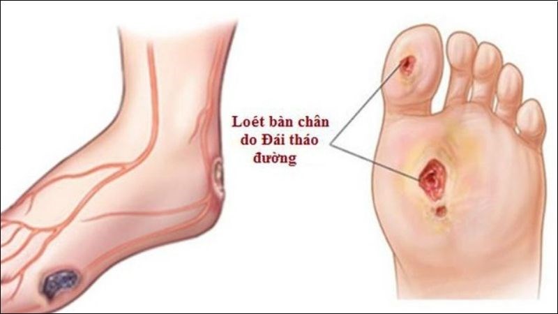Biến Chứng Thần Kinh Ở Người Tiểu Đường: Cần Thận Trọng Khi Xuất Hiện Triệu Chứng