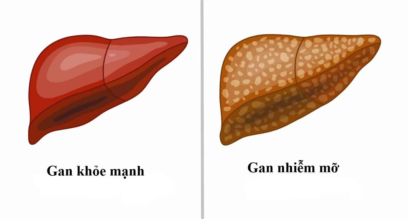 Tìm Hiểu Về Gan Nhiễm Mỡ: Nguyên Nhân, Rủi Ro Và Giải Pháp Hiệu Quả