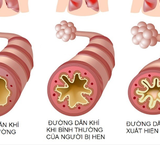 Những Dấu Hiệu Cần Lưu Ý Khi Trẻ Sặc Nước: Hướng Dẫn Cấp Cứu Tức Thì