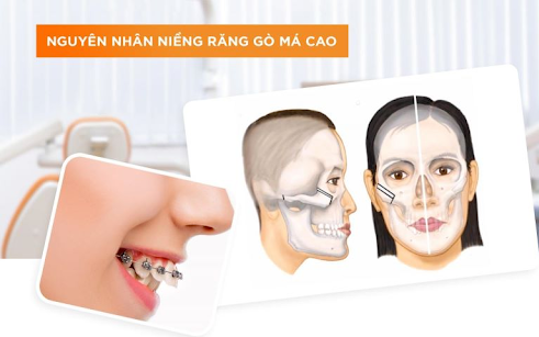 Khắc Phục Tình Trạng Hóp Má Khi Niềng Răng: Nguyên Nhân và Giải Pháp