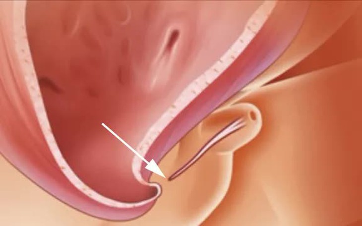 Khi nào nam giới thực sự cần phải cắt bao quy đầu - Ảnh 2.