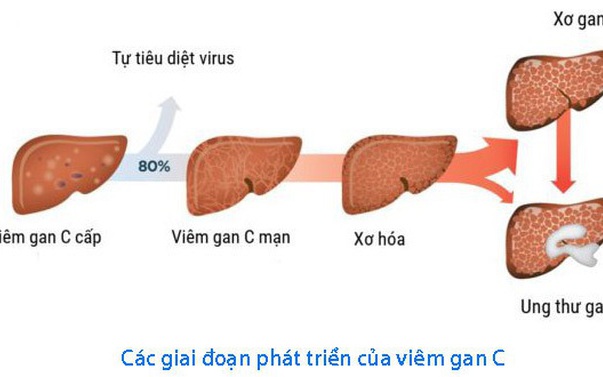 Đẩy Mạnh Cuộc Chiến Chống Viêm Gan Virus: Hướng Đến Mục Tiêu 2030