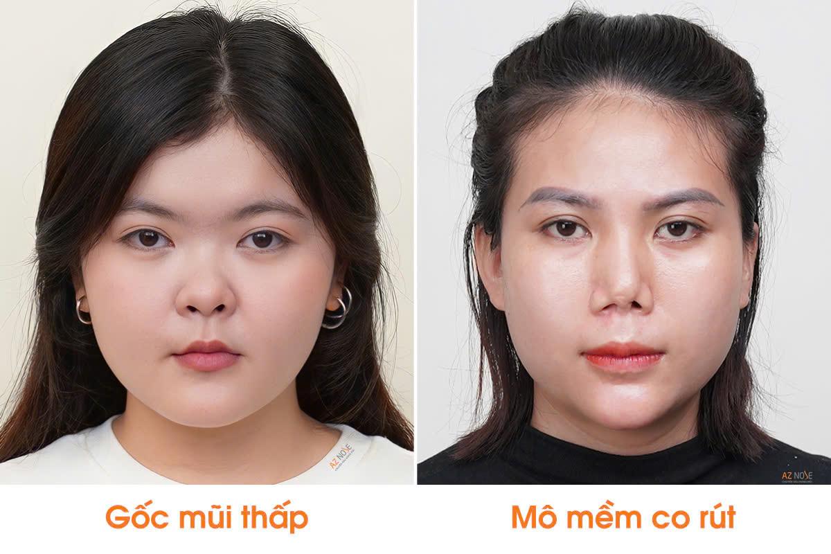 6 nguyên tắc bác sĩ cần đánh giá trước khi chỉnh mũi ngắn- Ảnh 2.