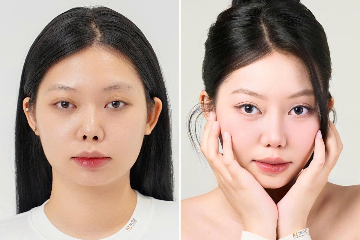 6 nguyên tắc bác sĩ cần đánh giá trước khi chỉnh mũi ngắn- Ảnh 4.