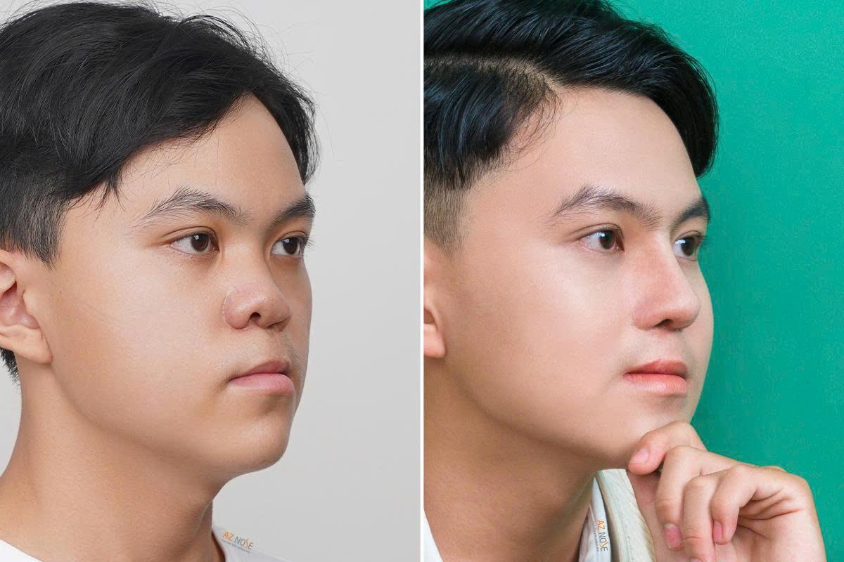 4 Tình Huống Nào Cần Phẫu Thuật Nâng Mũi Cấu Trúc?