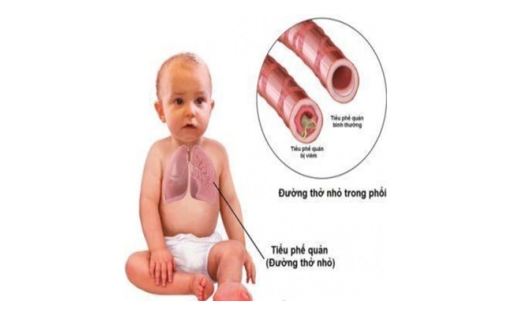 Giải Mã Viêm Tiểu Phế Quản Cấp Ở Trẻ: Nhận Biết Và Chăm Sóc Đúng Cách