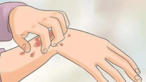 Cách Hiệu Quả Giảm Thiểu Khó Chịu Từ Viêm Da Thần Kinh