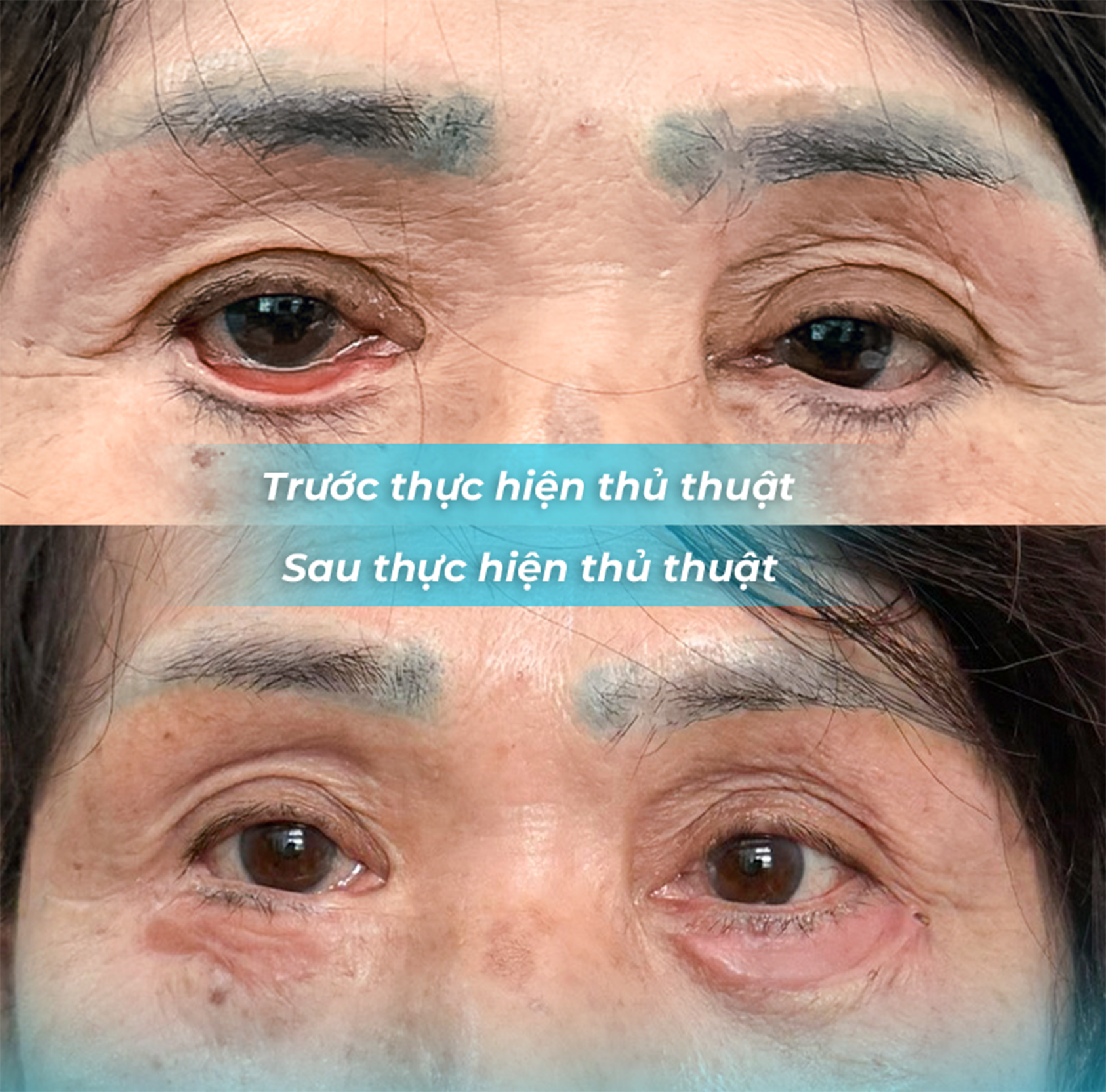 Biến Chứng Sau Phẫu Thuật Thẩm Mỹ: Câu Chuyện Của Một Nữ Bệnh Nhân