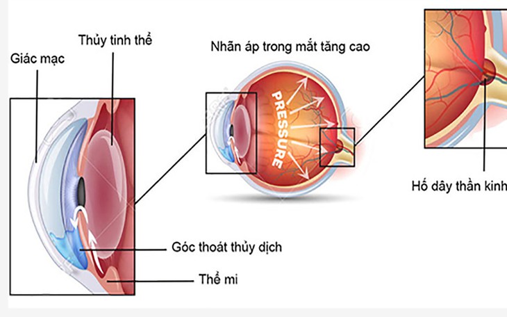 6 bước ngăn ngừa tăng nhãn áp gây hại thêm cho thị lực Phát hiện mới: Vitamin B3 giảm 66% nguy cơ mắc glôcôm ở người tăng nhãn áp? - Ảnh 3.