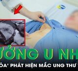 Câu Chuyện Cảnh Giác Khi Thực Hiện Bài Tập Squat Quá Mức