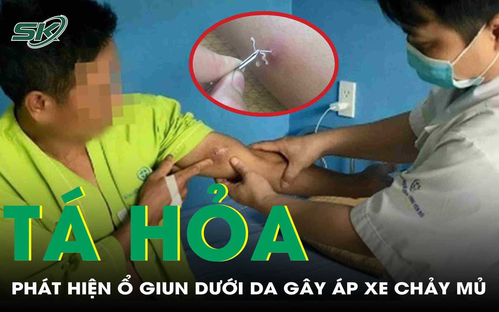 Ca Thứ 44 Bệnh Giun Rồng Tại Việt Nam: Những Thông Tin Cần Biết