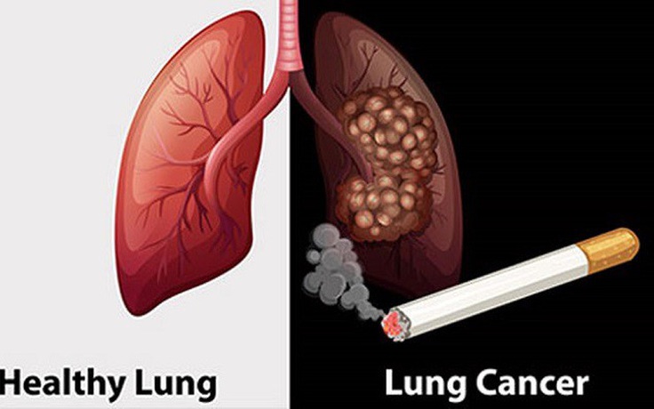 Những Thực Trạng Đáng Lo Ngại Về Ung Thư Phổi Tại Việt Nam