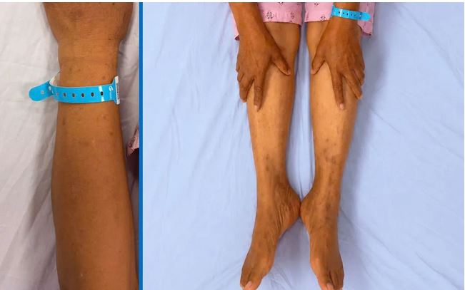 Nhận Diện Dấu Hiệu Tổn Thương Gan: Những Điều Cần Lưu Ý