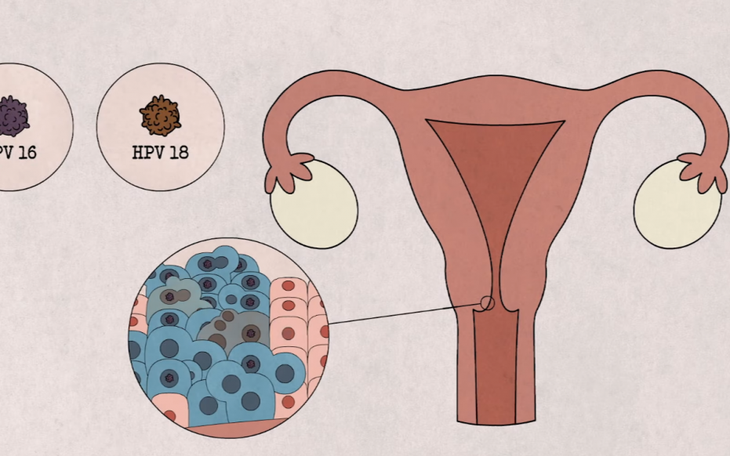 Tại Sao Cần Tầm Soát Ung Thư Cổ Tử Cung Mặc Dù Đã Tiêm Vaccine HPV?