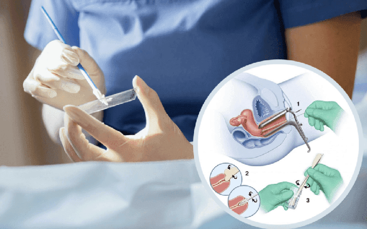 Phát hiện ung thư cổ tử cung qua xét nghiệm - Ảnh 2.