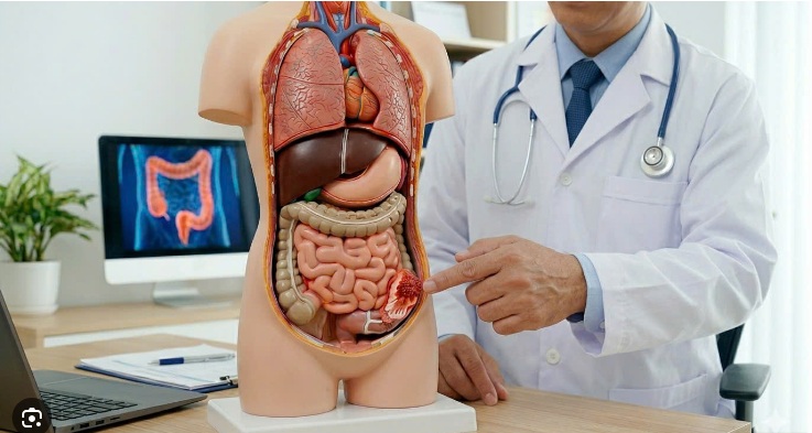 Thời Gian Sống Của Người Bệnh Ung Thư Đại Tràng Tùy Theo Giai Đoạn: Điều Cần Biết