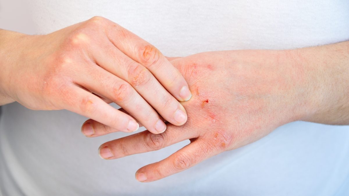 6 thói quen giúp kiểm soát viêm da cơ địa, giảm nguy cơ tái phát- Ảnh 2.