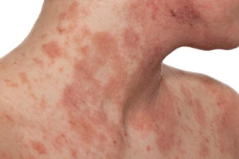 Cách Nhận Diện Viêm Da Cơ Địa và Phân Biệt Với Các Bệnh Da Khác