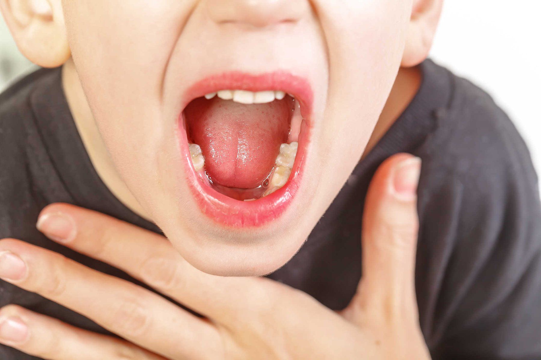 Những Dấu Hiệu Nhận Biết Viêm VA Ở Trẻ Em: Cấp Tính và Mạn Tính