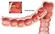 Tiêm vaccine zona tái tổ hợp ở người lớn tuổi: liệu có tác động đến nguy cơ tim mạch?