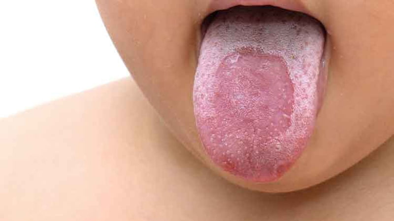 Những yếu tố làm tăng nguy cơ mắc lưỡi bản đồ- Ảnh 2.