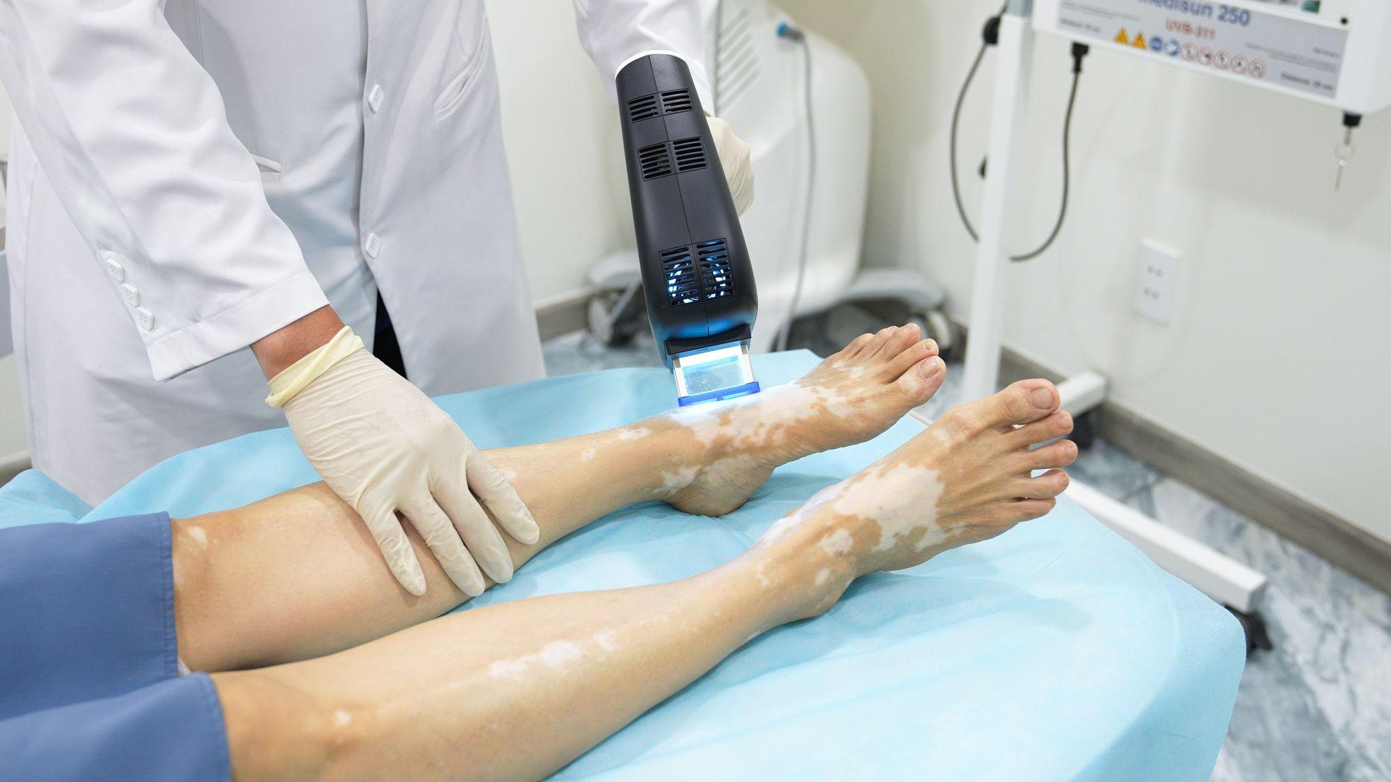 Excimer 308nm trong điều trị bạch biến: khi nào nên cân nhắc và những điều cần biết