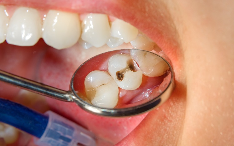 Nên uống nước trước hay sau khi đánh răng buổi sáng tốt cho sức khoẻ? - Ảnh 3.